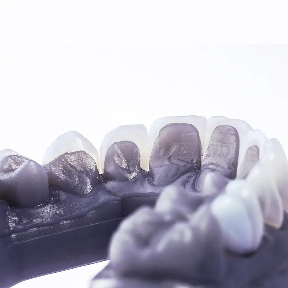 carillas dentales composite