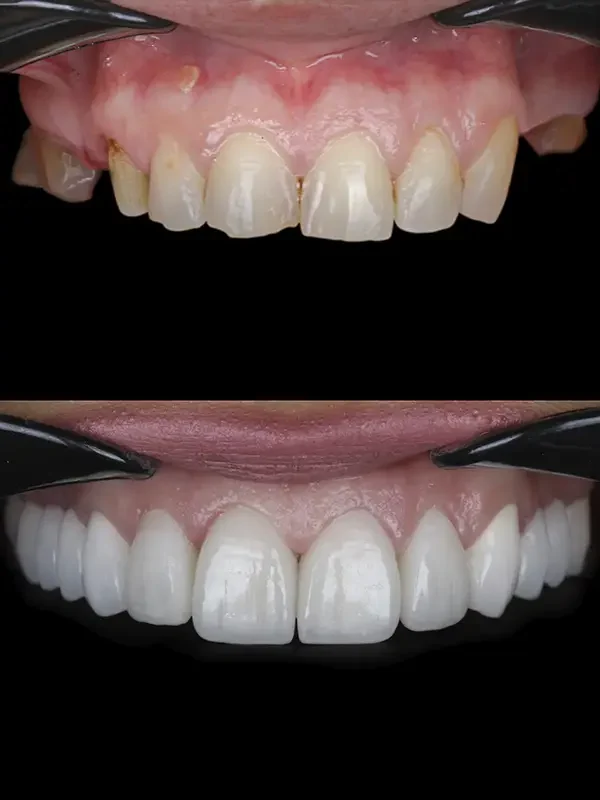 carillas dentales que son