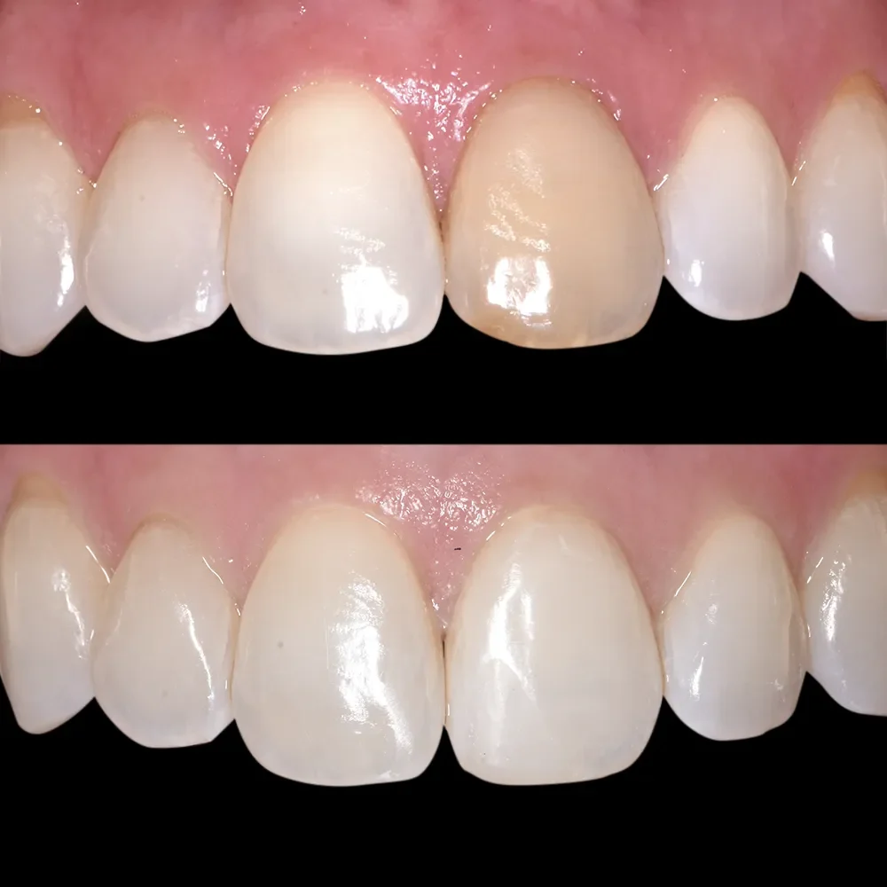 Resultado tratamiento de blanqueamiento dental