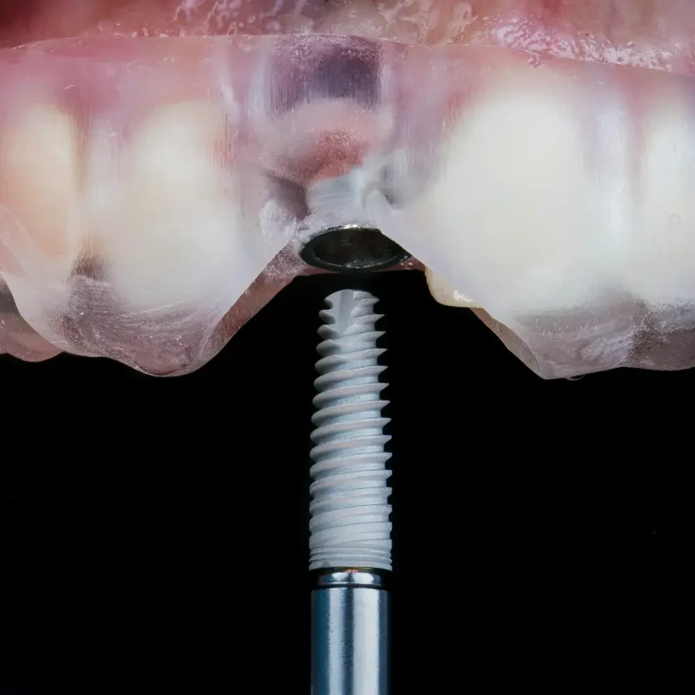 que son los implantes dentales